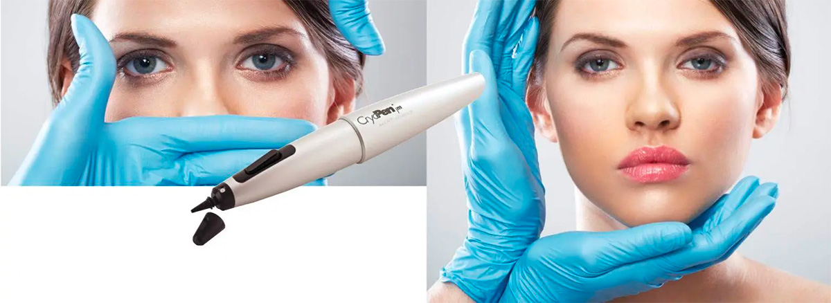 Cryotherapy cryopen treatments