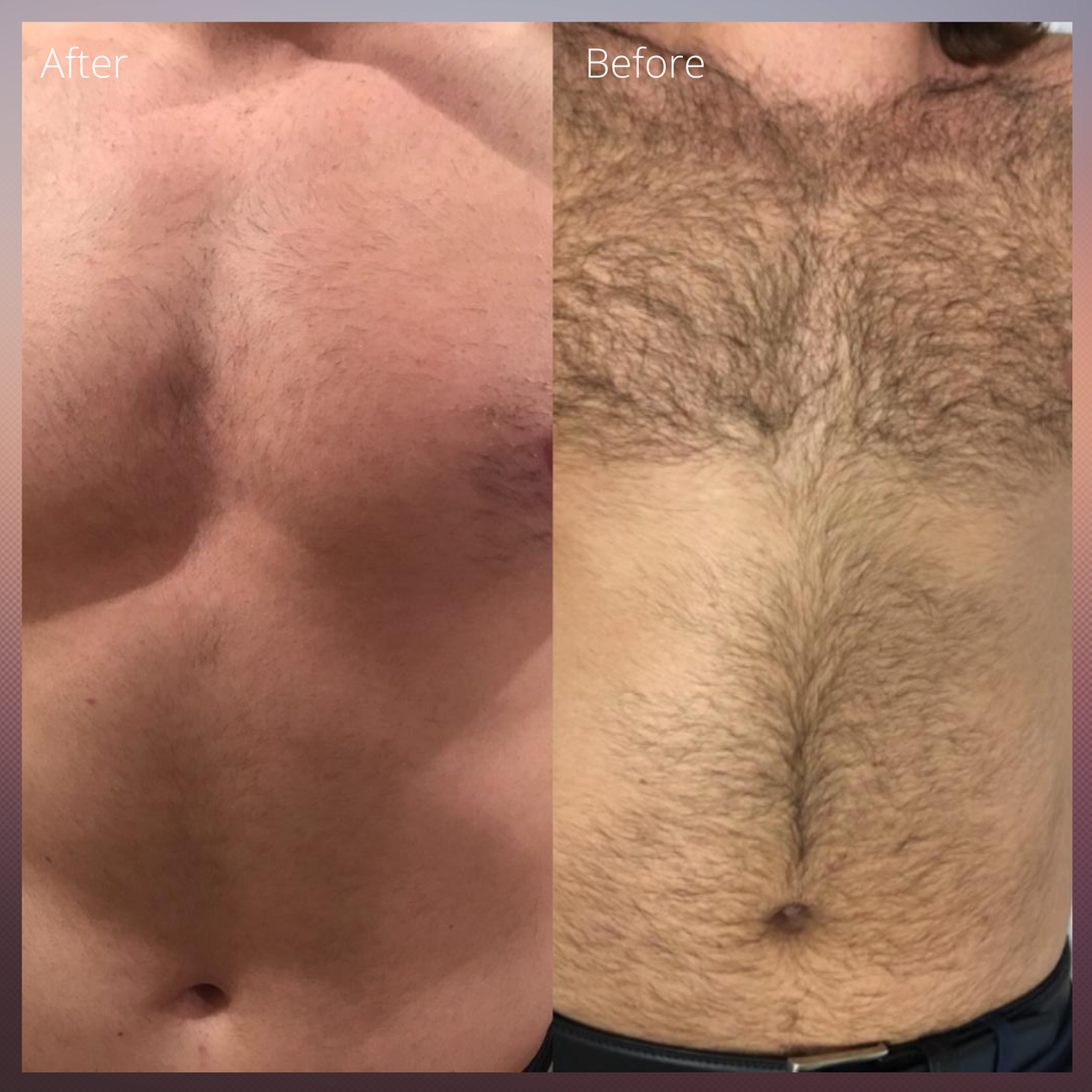 before and after chest laser hair removal