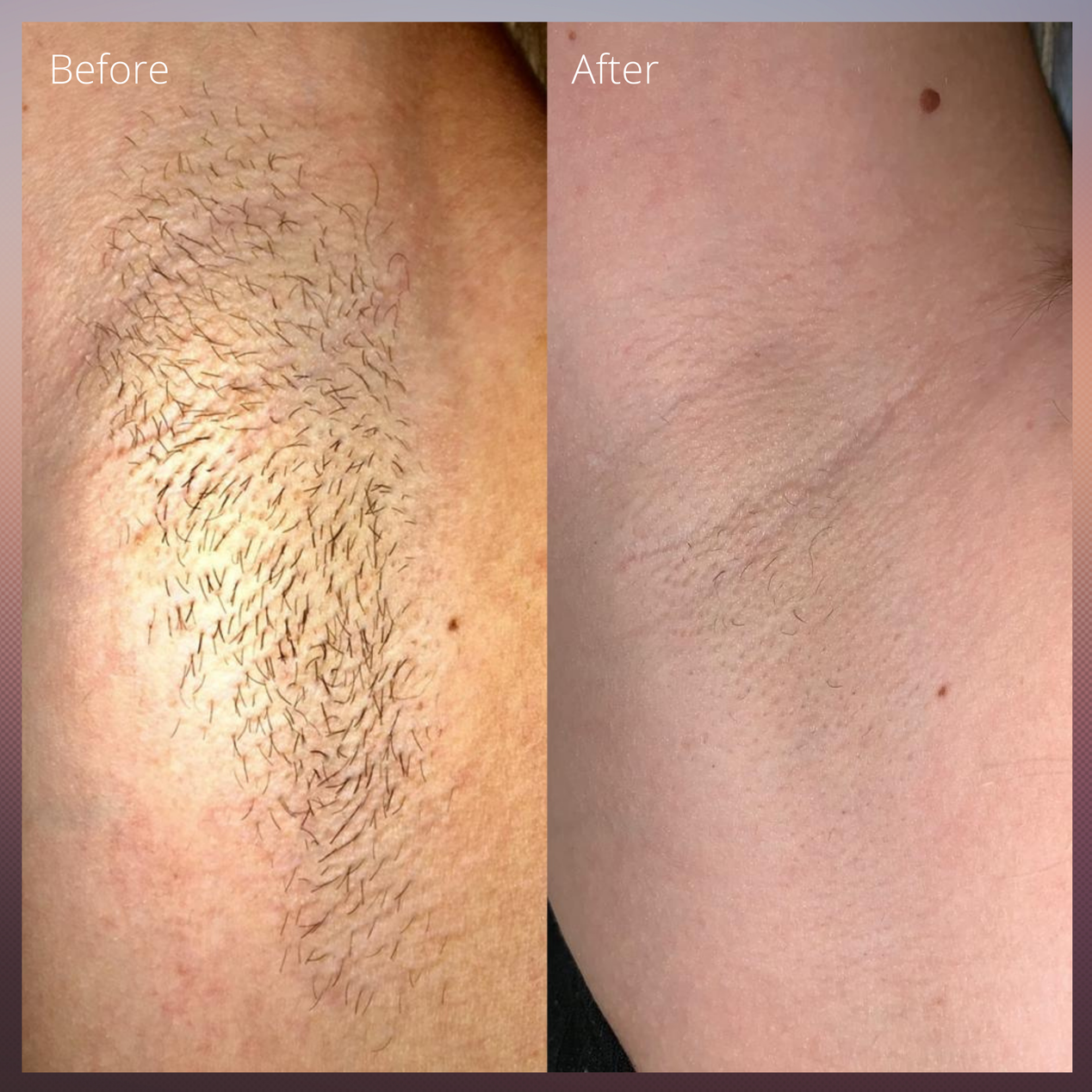before and after underarm laser