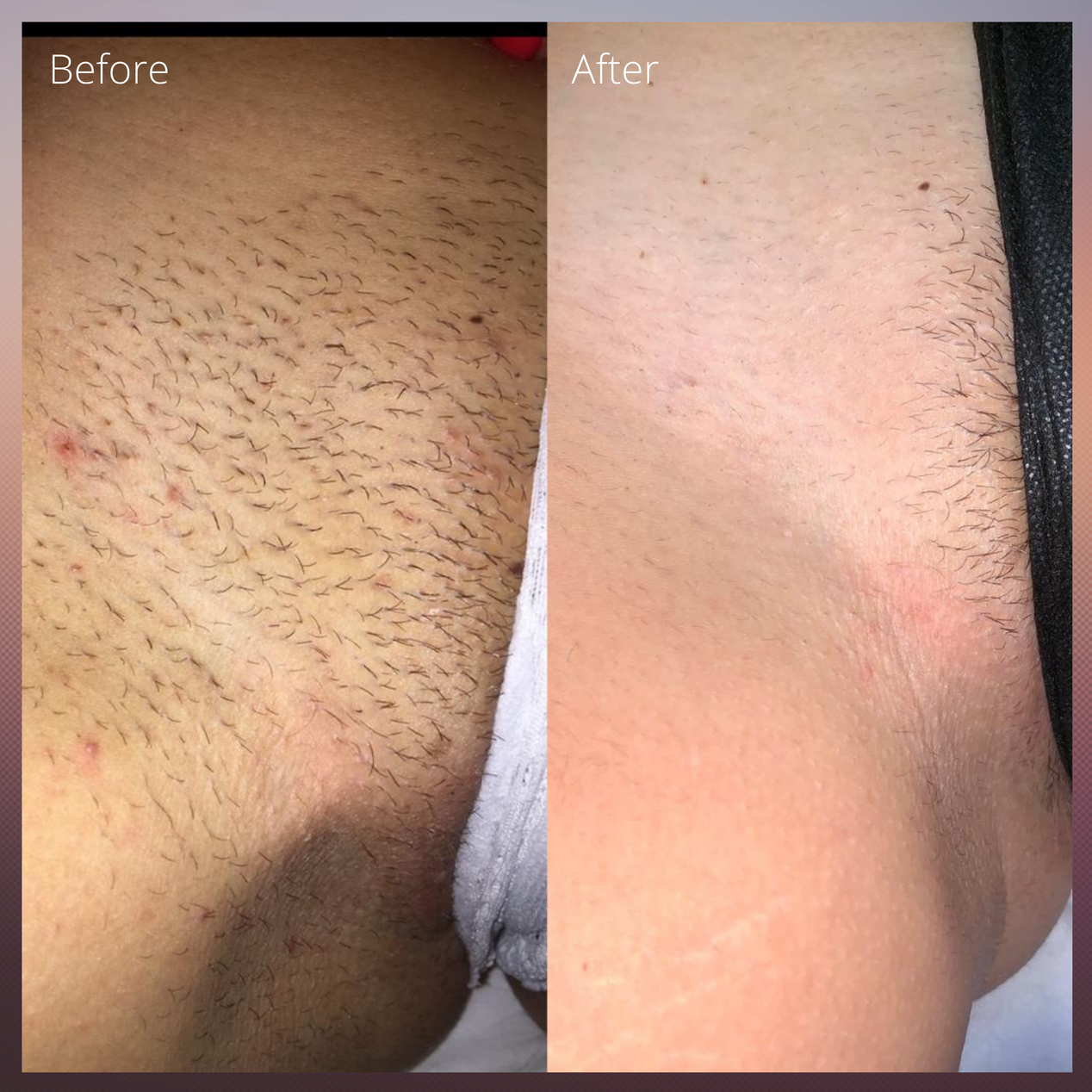 before and after bikini laser hair removal